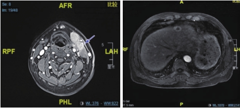 图2（2） 喉MRI及腹部MRI（2疗程后）